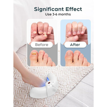 Glowence Nail Fungus Device