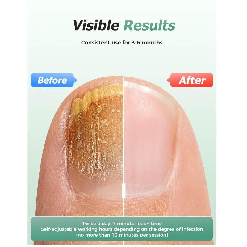 Glowence Nail Fungus Device