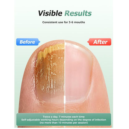 Glowence Nail Fungus Device