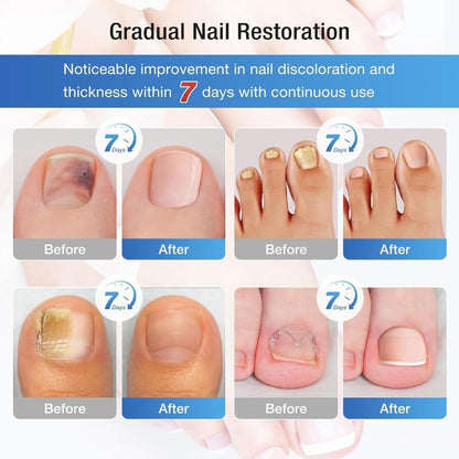 Glowence Nail Fungus Device